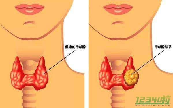 甲状腺结节手术前准备 这六大准备事项你都清楚吗？